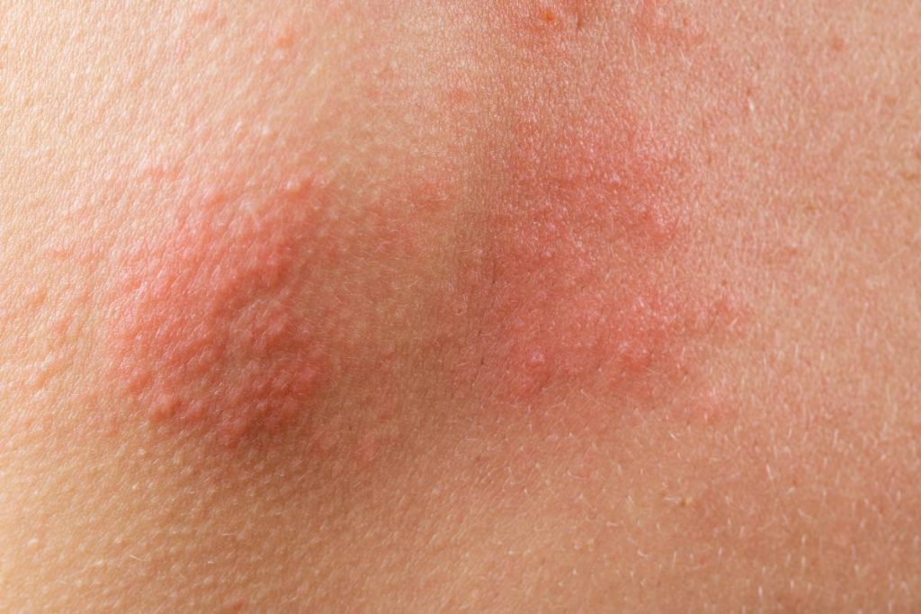 chickenpox rash. Shingles, varicella-zoster virus. skin rash and blisters on body. Skin infected Herpes zoster virus. Herpes Virus on body. urticaria rash. atopic dermatitis.