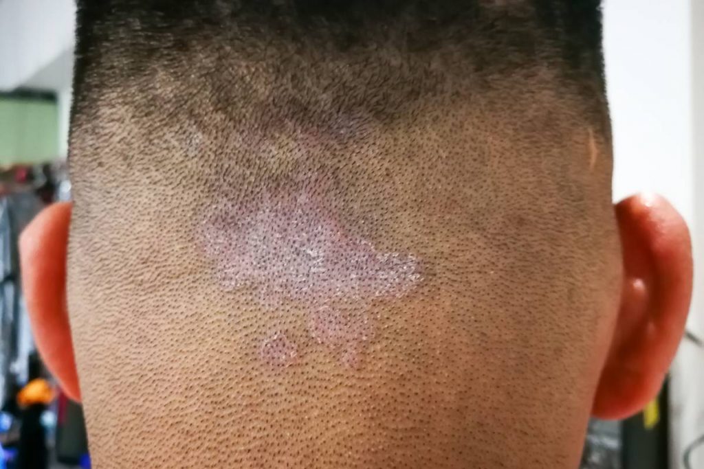 Closed up of ringworm also known as tinea on he scalp of the head. Dermatitis problem.
