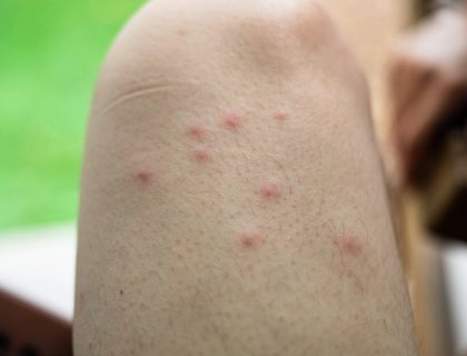 Red swollen blisters on the skin caused by bed bugs bites at thigh